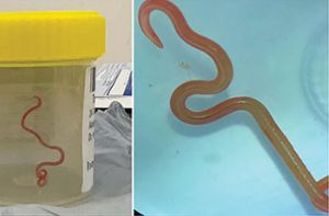 Das undatiertes Bild zeigt einen lebenden Spulwurm „Ophidascaris robertsi“, der im Gehirn einer 64-jährigen Australierin gefunden wurde. In einem Krankenhaus in Canberra haben Ärzte einen lebendigen, acht Zentimeter langen Rundwurm aus dem Gehirn einer 64-jährigen Frau entfernt. Foto: Emerging Infectious Diseases/AP/dpa