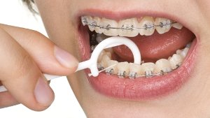 Zahnspange – Das gilt es zu beachten