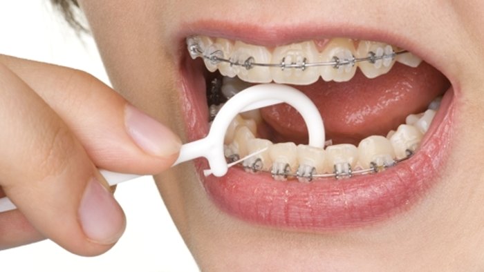 Zahnspange – Das gilt es zu beachten