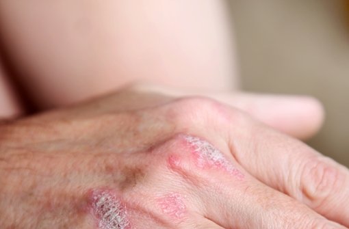 Die Hautkrankheit Schuppenflechte gehört zu den Autoimmunerkrankungen Foto: Fotolia
