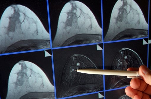 Auf der Bildschirmdarstellung einer Magnetresonanz-(MR)-Mammographie ist ein winziger Tumor in der Brust einer Patientin zu sehen. Foto: dpa-Zentralbild