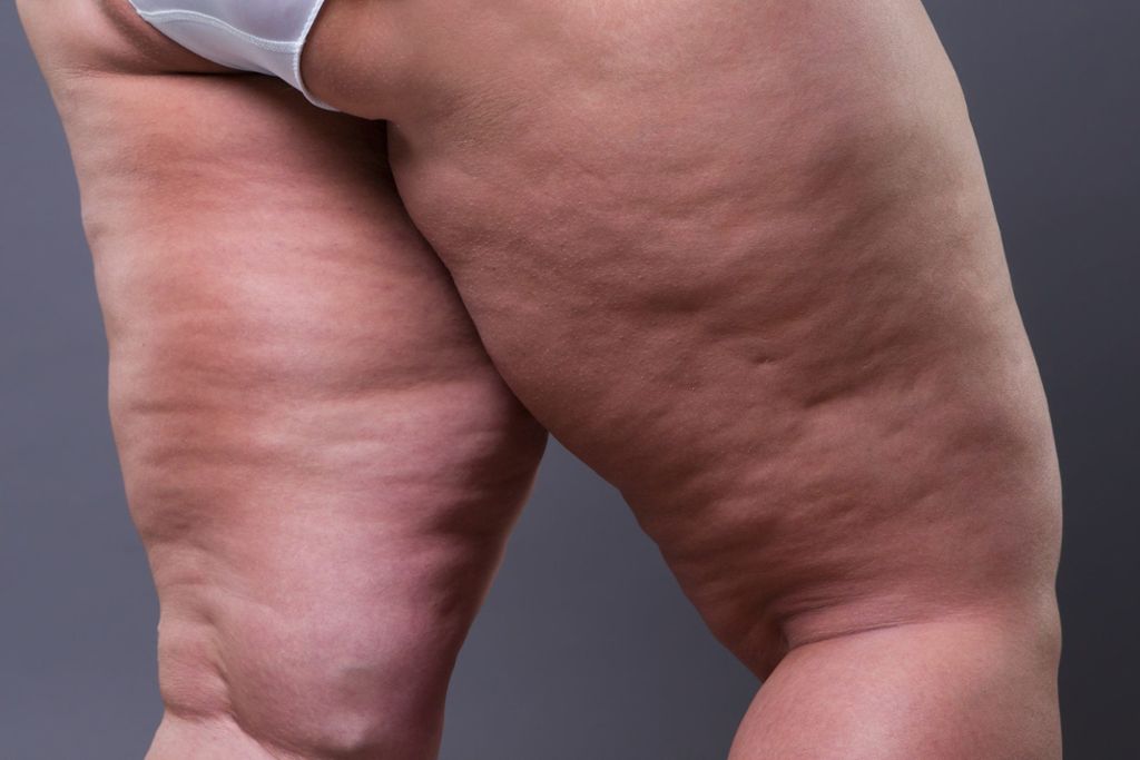 Lipödem-Patienten leiden unter dicken Armen und Beinen. Die Fettstörung ist oft mit Schmerzen verbunden. (Symbolbild) Foto: staras - stock.adobe.com