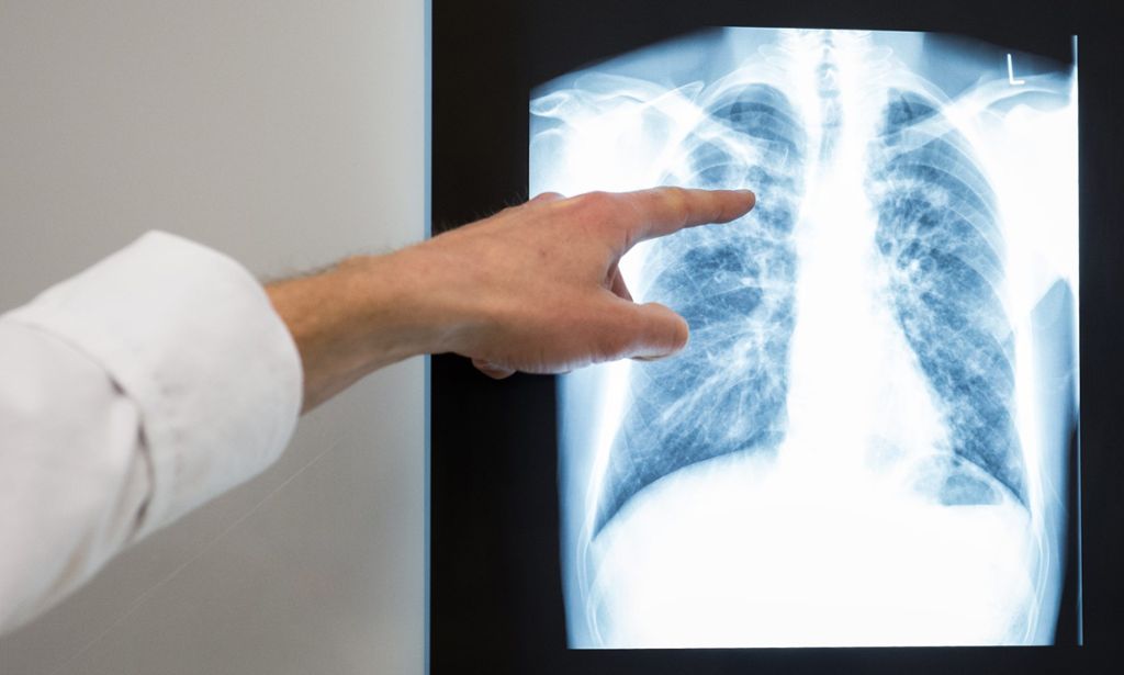 Per Röntgenuntersuchung sollen auch im Kreis Rottweil Fälle der Lungentuberkulose rechtzeitig entdeckt werden. Foto: dpa
