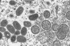 Diese elektronenmikroskopische Aufnahme aus dem Jahr 2003, die von den Centers for Disease Control and Prevention zur Verfügung gestellt wurde, zeigt reife, ovale Affenpockenviren und kugelförmige unreife Virionen. Foto: Cynthia S. Goldsmith/Russell Regner/CDC/AP/dpa