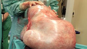 Ärzte entfernen 32 Kilogramm schweren Tumor einer Frau
